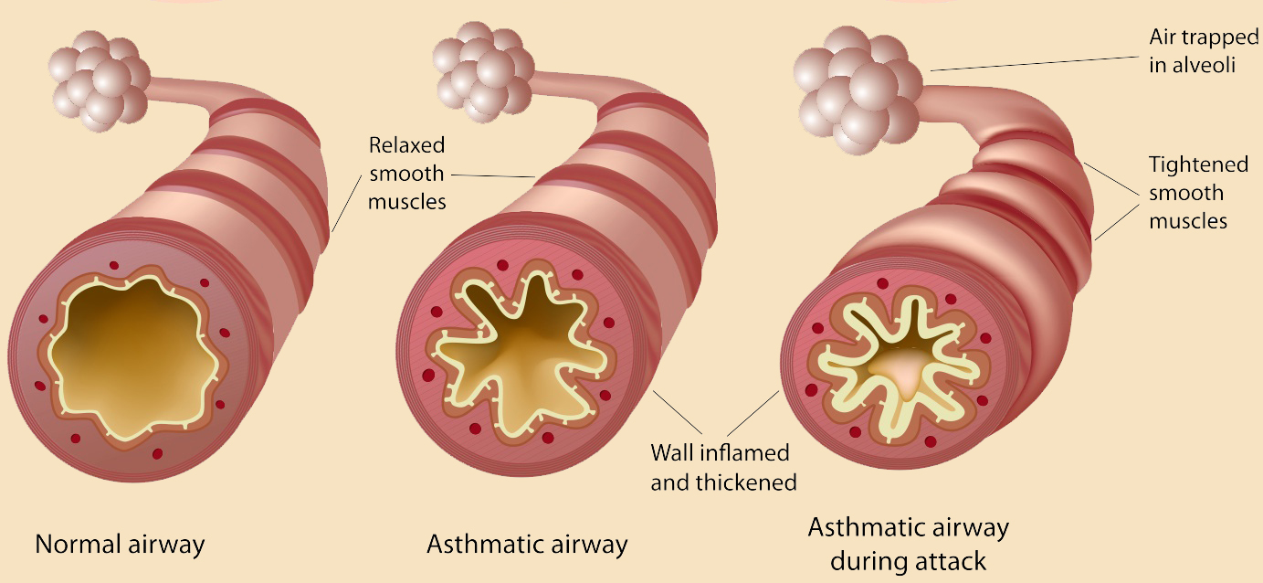 Anaphylaxis Asthma
